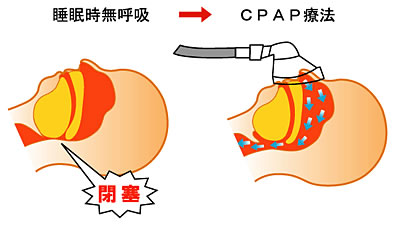 CPAP療法