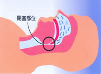 3.睡眠時無呼吸症候群(SAS)になる原因と頻度を観てみましょう