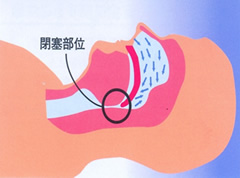 3.睡眠時無呼吸症候群（SAS）になる原因と頻度を観てみましょう