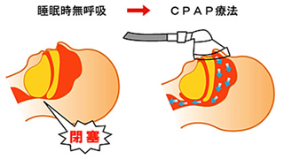 CPAP療法